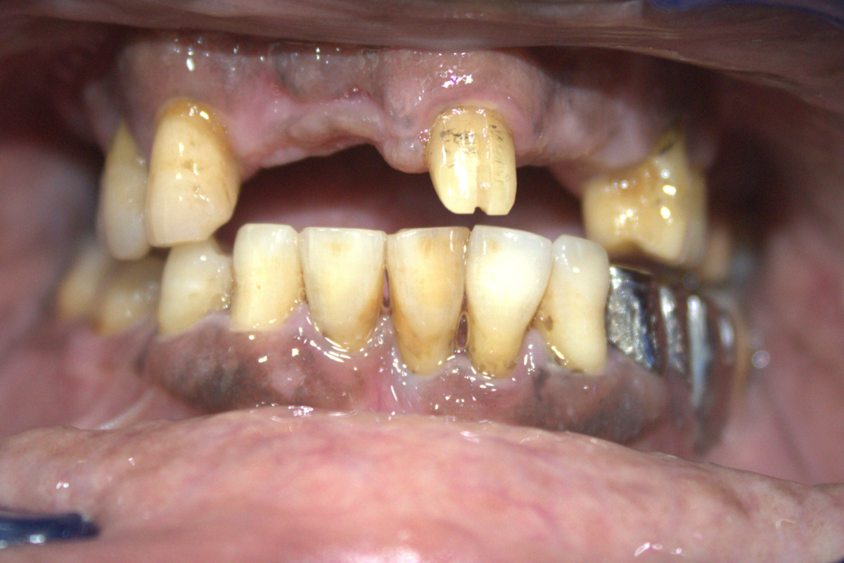 Before Treatment